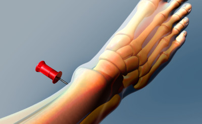 IO Needle Insertion, Medical Animation
