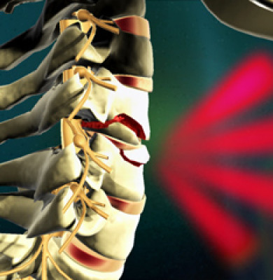 Medical Animation Spinal Cord Treatment