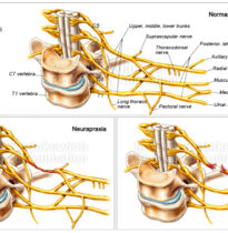 Obstetrical Brachial Plexus Injuries