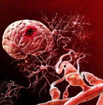 Ischemic Brain Damage (Dr. Michael Tymianski, Toronto Western Hospital, Div. of Neurosurgery)