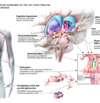Parkinson's Disease illustration (Client - Dr. Anthony Lang)