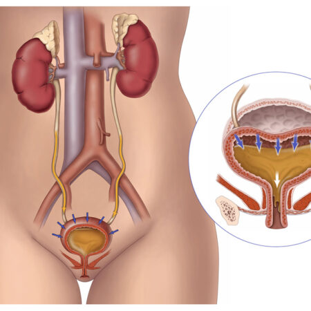 Conceptual illustration of Overactive Bladder