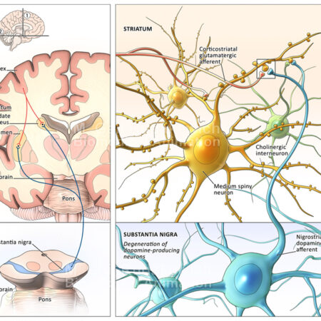 The Anatomy of Parkinson's Disease (Dr. Mario Masellis, Sunnybrook Health Sciences Centre)