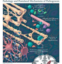 Multiple Sclerosis on a cellular level, the demyelination of neurons in acute and chronic lesions, and the postulated mechanisms of pathogenesis