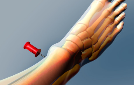 IO Needle Insertion, Medical Animation