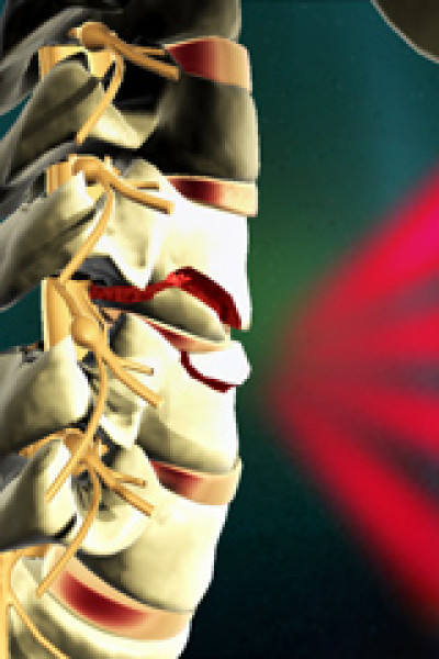 Medical Animation Spinal Cord Treatment