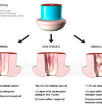 Trachelectomy (Anatomic Pathology, Sunnybrook Health Sciences Centre)
