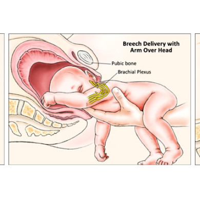 Brachial Plexus, Mechanisms of Injury (Client: Dr. Raymond Tse)