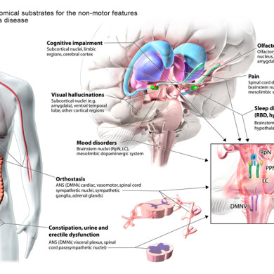 Parkinson's Disease illustration (Client - Dr. Anthony Lang)